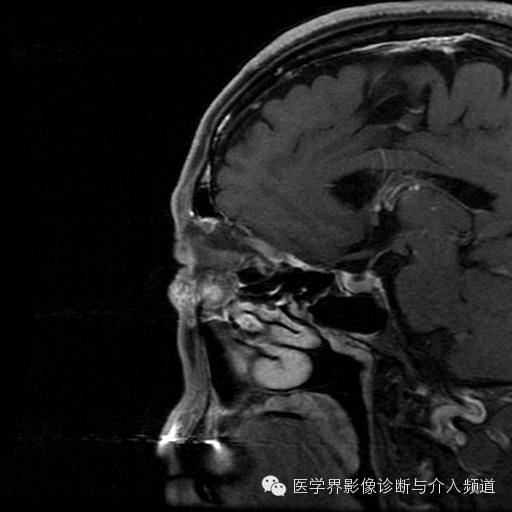 【病例】眼眶海绵状血管瘤1例MR影像表现 【病例】眼眶海绵状血管瘤1例MR影像表现