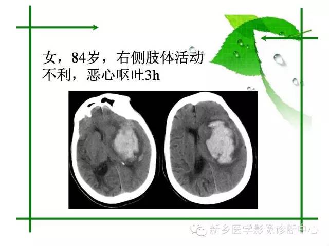 【PPT】颅内出血的MR诊断