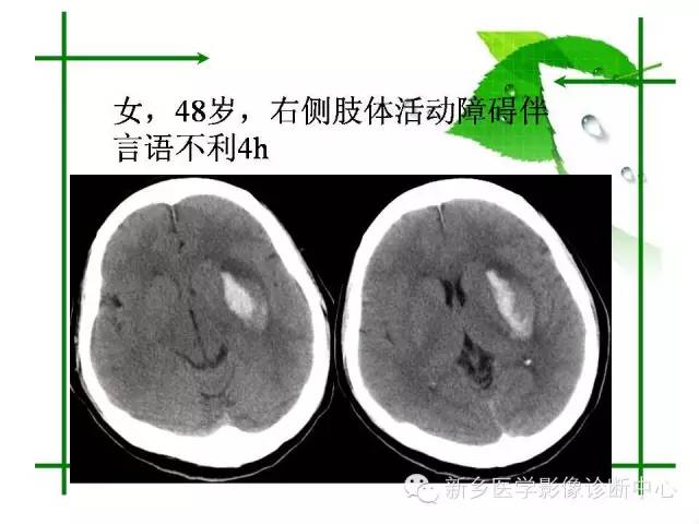 【PPT】颅内出血的MR诊断