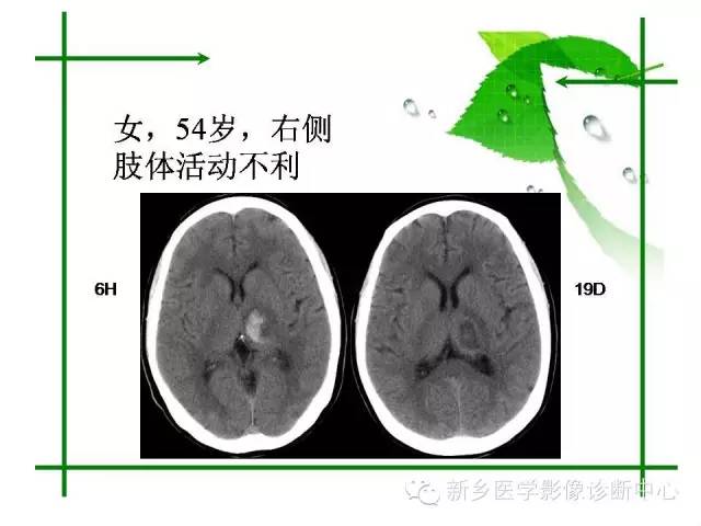 【PPT】颅内出血的MR诊断