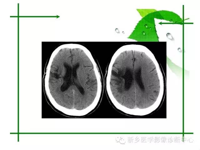 【PPT】颅内出血的MR诊断