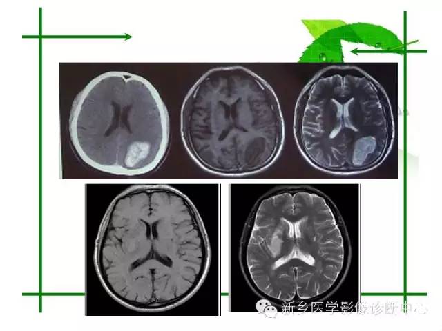 【PPT】颅内出血的MR诊断