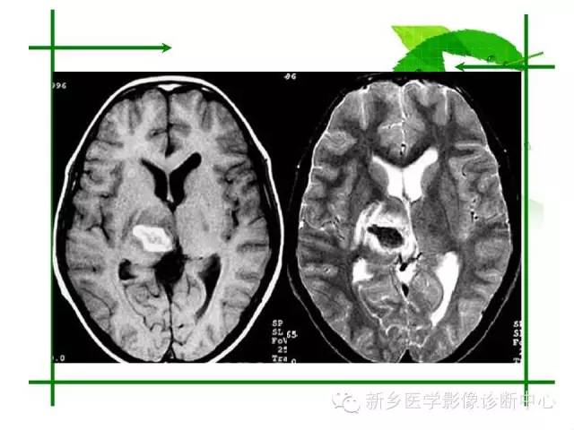 【PPT】颅内出血的MR诊断