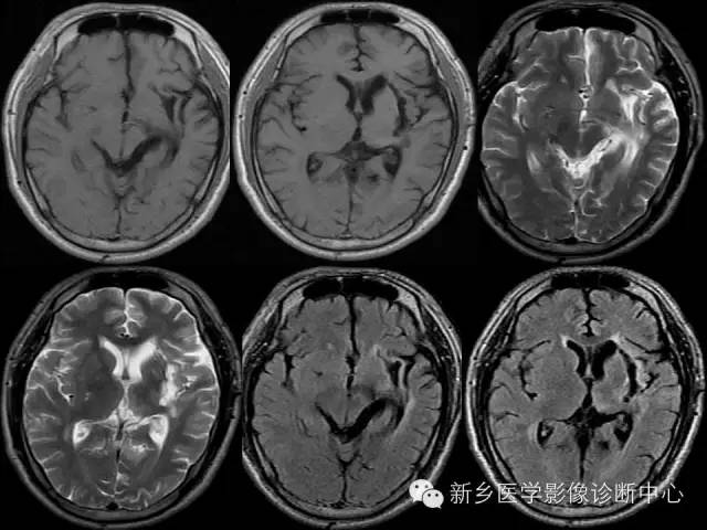 【PPT】颅内出血的MR诊断