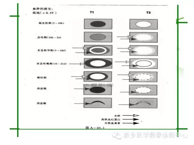 【PPT】颅内出血的MR诊断