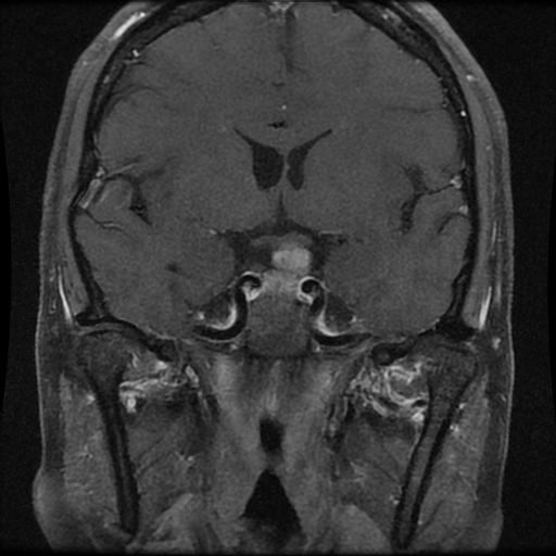 【病例】鞍区脑膜瘤1例MR影像表现 【病例】鞍区脑膜瘤1例MR影像表现