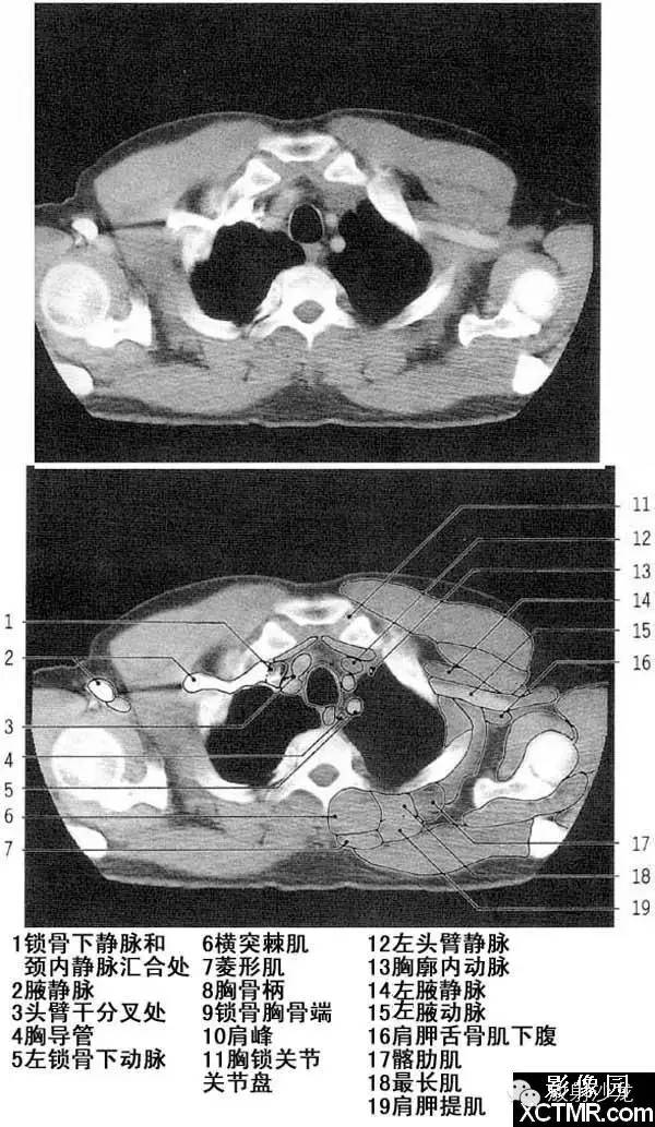 胸部CT断层解剖（纵隔窗）