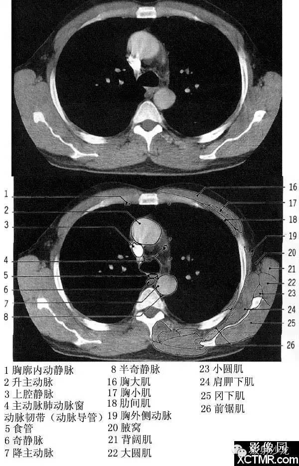 胸部CT断层解剖（纵隔窗）