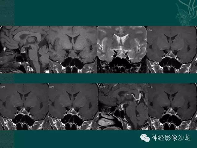 【病例】淋巴细胞性垂体炎1例MR影像表现