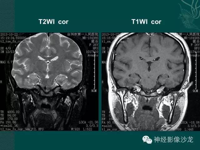 【病例】淋巴细胞性垂体炎1例MR影像表现