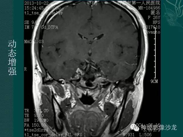 【病例】淋巴细胞性垂体炎1例MR影像表现