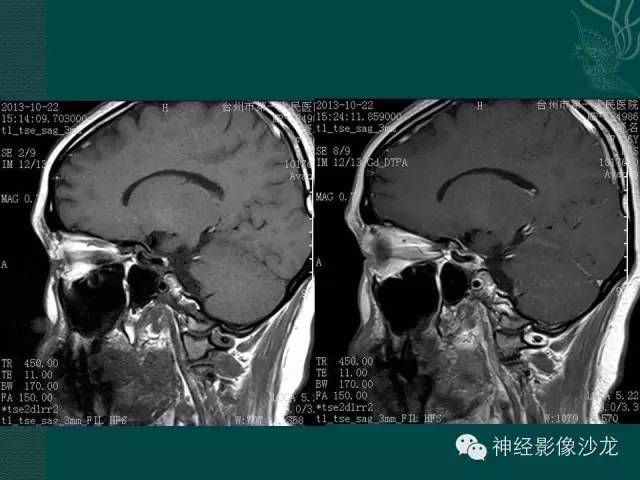 【病例】淋巴细胞性垂体炎1例MR影像表现