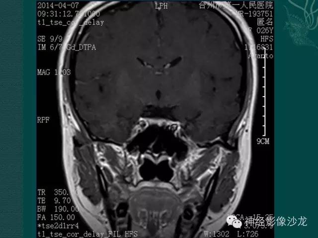 【病例】淋巴细胞性垂体炎1例MR影像表现