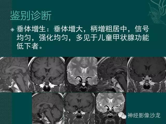 【病例】淋巴细胞性垂体炎1例MR影像表现