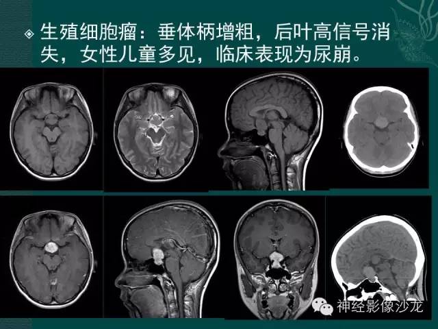 【病例】淋巴细胞性垂体炎1例MR影像表现