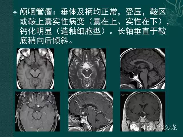 【病例】淋巴细胞性垂体炎1例MR影像表现