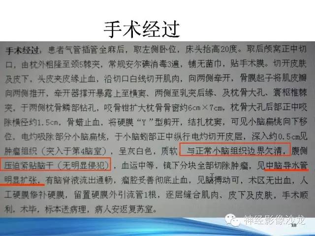 【病例】髓母细胞瘤1例MR影像表现