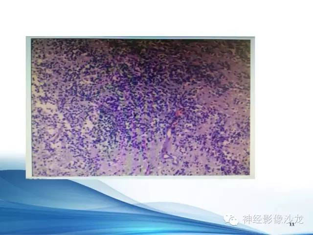 【病例】髓母细胞瘤1例MR影像表现