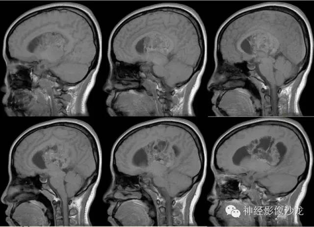 【病例】中枢神经细胞瘤1例MR影像表现