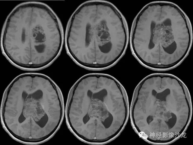 【病例】中枢神经细胞瘤1例MR影像表现 【病例】中枢神经细胞瘤1例MR影像表现