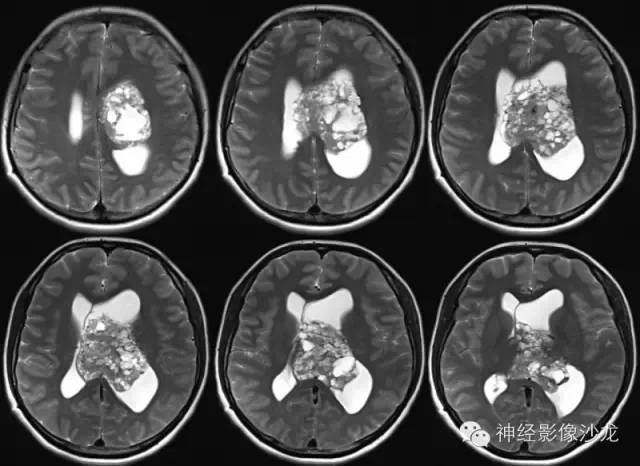 【病例】中枢神经细胞瘤1例MR影像表现 【病例】中枢神经细胞瘤1例MR影像表现
