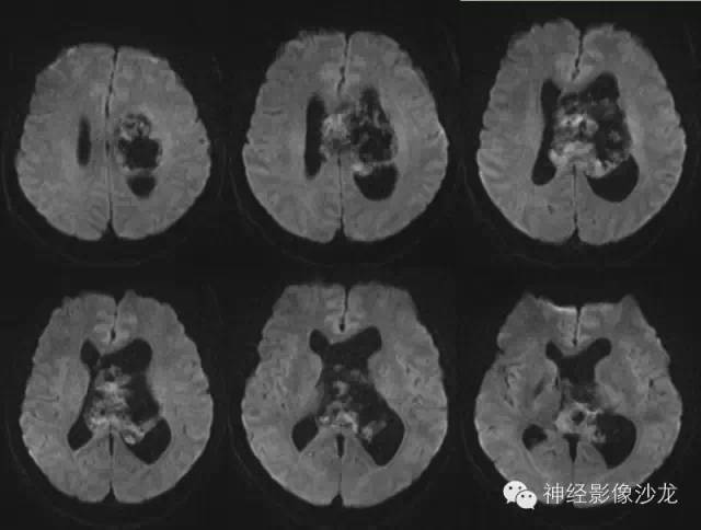 【病例】中枢神经细胞瘤1例MR影像表现 【病例】中枢神经细胞瘤1例MR影像表现