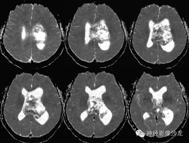 【病例】中枢神经细胞瘤1例MR影像表现 【病例】中枢神经细胞瘤1例MR影像表现