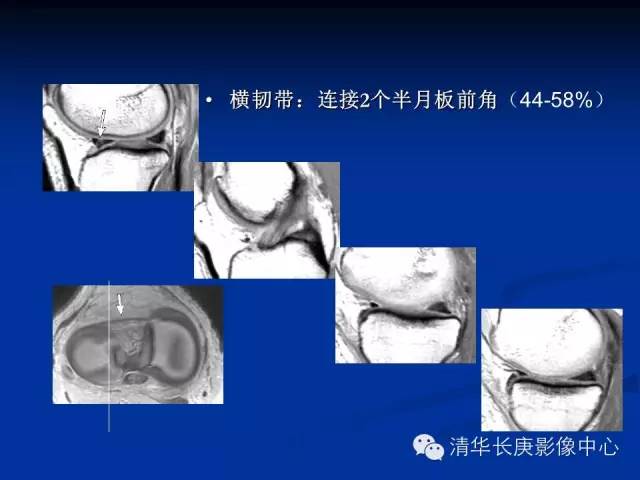 半月板的MR评价 半月板的MR评价