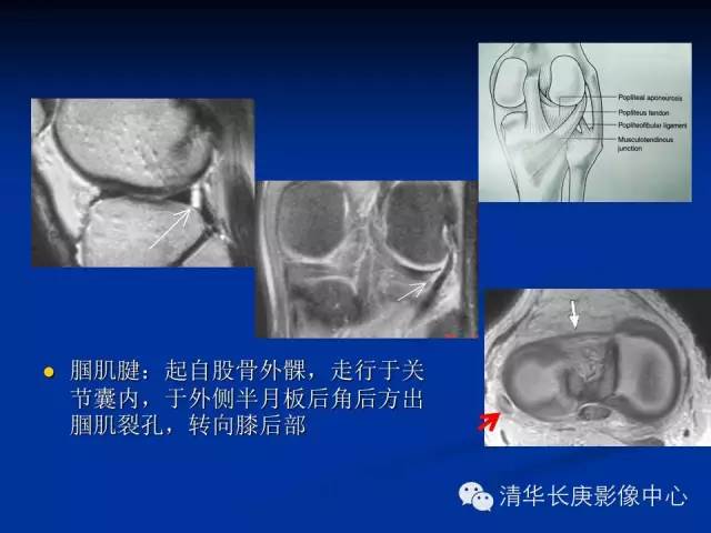 半月板的MR评价 半月板的MR评价