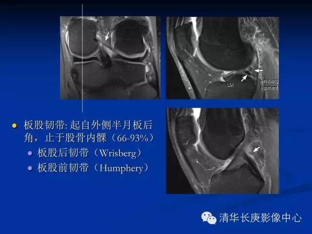 半月板的MR评价 半月板的MR评价
