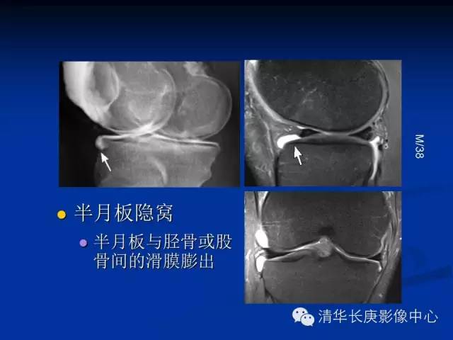 半月板的MR评价 半月板的MR评价