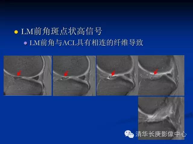 半月板的MR评价 半月板的MR评价
