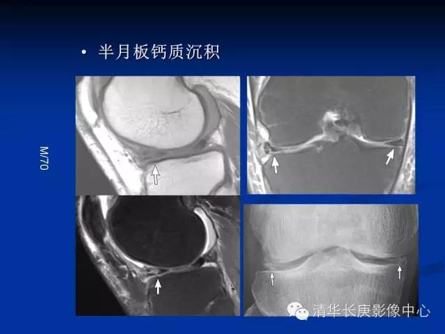 半月板的MR评价 半月板的MR评价