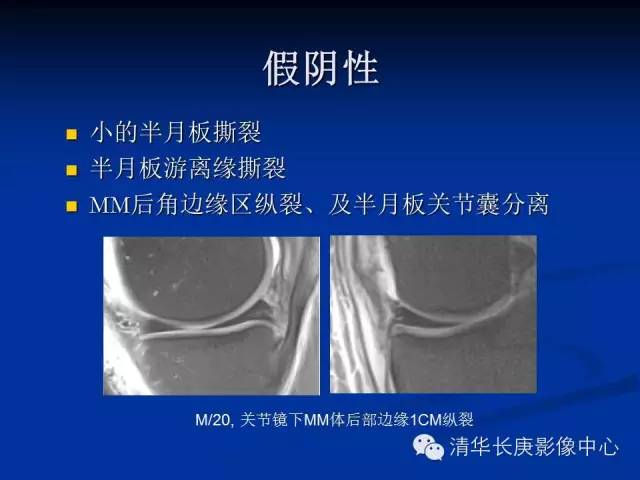 半月板的MR评价 半月板的MR评价