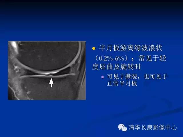 半月板的MR评价 半月板的MR评价