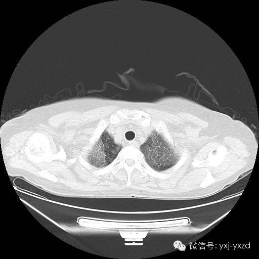 【病例】肺泡蛋白沉积症1例CT影像表现 【病例】肺泡蛋白沉积症1例CT影像表现