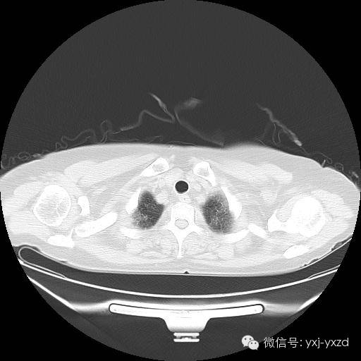 【病例】肺泡蛋白沉积症1例CT影像表现