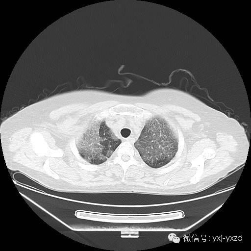 【病例】肺泡蛋白沉积症1例CT影像表现 【病例】肺泡蛋白沉积症1例CT影像表现