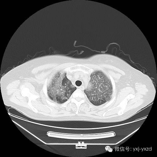 【病例】肺泡蛋白沉积症1例CT影像表现 【病例】肺泡蛋白沉积症1例CT影像表现