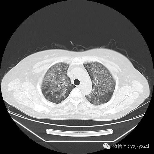 【病例】肺泡蛋白沉积症1例CT影像表现 【病例】肺泡蛋白沉积症1例CT影像表现