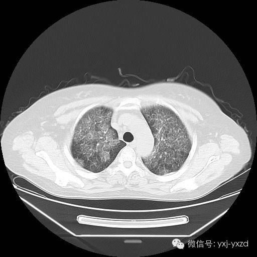 【病例】肺泡蛋白沉积症1例CT影像表现 【病例】肺泡蛋白沉积症1例CT影像表现