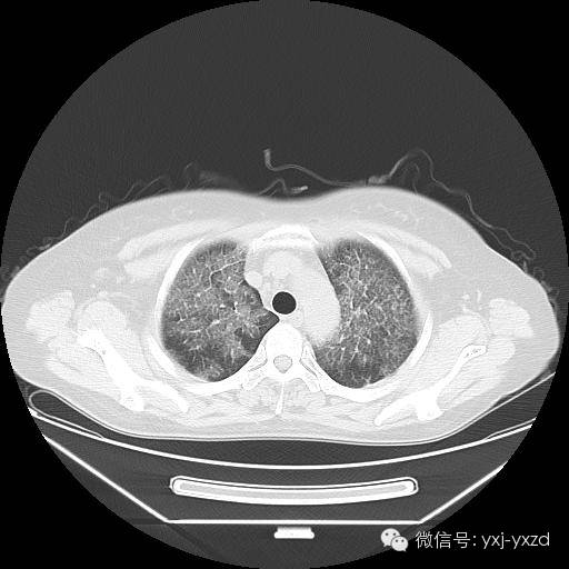 【病例】肺泡蛋白沉积症1例CT影像表现 【病例】肺泡蛋白沉积症1例CT影像表现