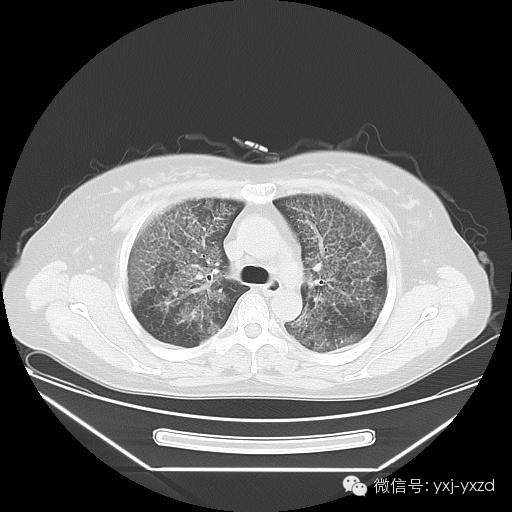 【病例】肺泡蛋白沉积症1例CT影像表现 【病例】肺泡蛋白沉积症1例CT影像表现
