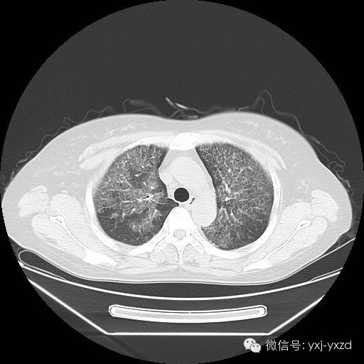 【病例】肺泡蛋白沉积症1例CT影像表现 【病例】肺泡蛋白沉积症1例CT影像表现