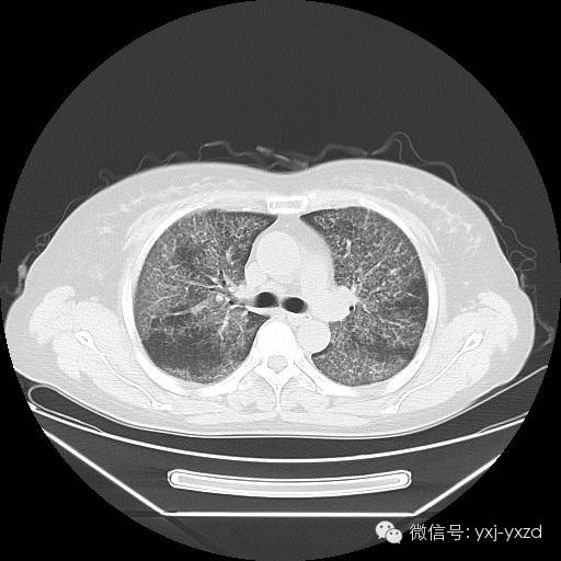 【病例】肺泡蛋白沉积症1例CT影像表现 【病例】肺泡蛋白沉积症1例CT影像表现