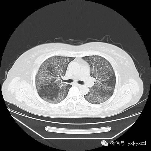 【病例】肺泡蛋白沉积症1例CT影像表现 【病例】肺泡蛋白沉积症1例CT影像表现