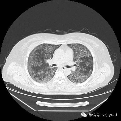 【病例】肺泡蛋白沉积症1例CT影像表现 【病例】肺泡蛋白沉积症1例CT影像表现