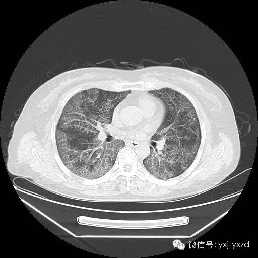 【病例】肺泡蛋白沉积症1例CT影像表现 【病例】肺泡蛋白沉积症1例CT影像表现