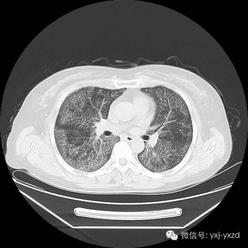 【病例】肺泡蛋白沉积症1例CT影像表现 【病例】肺泡蛋白沉积症1例CT影像表现