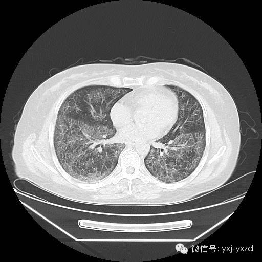 【病例】肺泡蛋白沉积症1例CT影像表现 【病例】肺泡蛋白沉积症1例CT影像表现